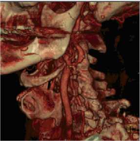 3D CT scan showing narrow artery