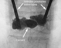 X-ray showing needle paths and cement at fracture site 